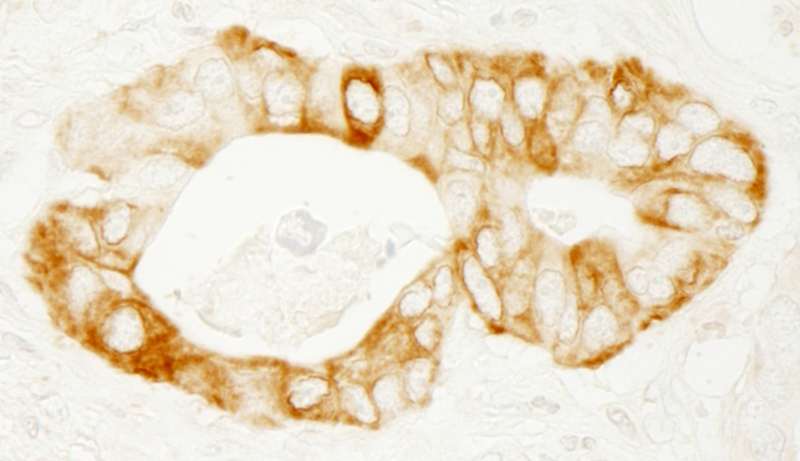 Detection of Human PKD2 by Immunohistochemistry. Sample: FFPE section of human stomach carcinoma. Antibody: Affinity purified rabbit anti-PKD1 used at a dilution of 1:1000 (1 ug/ml). Detection: DAB.