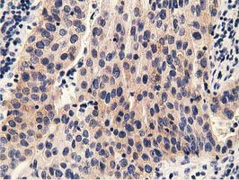 IHC of paraffin-embedded Carcinoma of Human bladder tissue using anti-PRKD2 mouse monoclonal antibody.