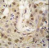 Formalin-fixed and paraffin-embedded human lung carcinoma tissue reacted with cGKII antibody , which was peroxidase-conjugated to the secondary antibody, followed by DAB staining. This data demonstrates the use of this antibody for immunohistochemistry; clinical relevance has not been evaluated.