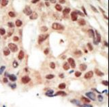 Formalin-fixed and paraffin-embedded human cancer tissue reacted with the primary antibody, which was peroxidase-conjugated to the secondary antibody, followed by AEC staining. This data demonstrates the use of this antibody for immunohistochemistry; clinical relevance has not been evaluated. BC = breast carcinoma; HC = hepatocarcinoma.
