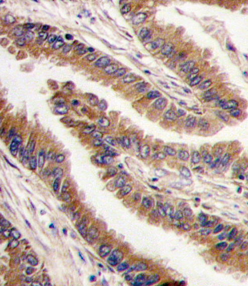 Formalin-fixed and paraffin-embedded human lung carcinoma tissue reacted with PRKX antibody , which was peroxidase-conjugated to the secondary antibody, followed by DAB staining. This data demonstrates the use of this antibody for immunohistochemistry; clinical relevance has not been evaluated.