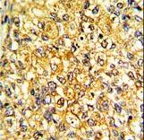 Formalin-fixed and paraffin-embedded human breast carcinoma with PRL-S163 Antibody, which was peroxidase-conjugated to the secondary antibody, followed by DAB staining. This data demonstrates the use of this antibody for immunohistochemistry; clinical relevance has not been evaluated.