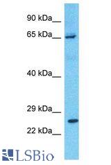 PRLR / Prolactin Receptor antibody Western Blot of Lymph Node Tumor. Antibody dilution: 1 ug/ml.