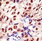 Formalin-fixed and paraffin-embedded human cancer tissue reacted with the primary antibody, which was peroxidase-conjugated to the secondary antibody, followed by DAB staining. This data demonstrates the use of this antibody for immunohistochemistry; clinical relevance has not been evaluated. BC = breast carcinoma; HC = hepatocarcinoma.