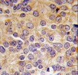 Formalin-fixed and paraffin-embedded human prostate carcinoma tissue reacted with PRMT3 antibody , which was peroxidase-conjugated to the secondary antibody, followed by DAB staining. This data demonstrates the use of this antibody for immunohistochemistry; clinical relevance has not been evaluated.