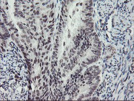 IHC of paraffin-embedded Adenocarcinoma of Human endometrium tissue using anti-MLF2 mouse monoclonal antibody. (Heat-induced epitope retrieval by 10mM citric buffer, pH6.0, 100C for 10min).