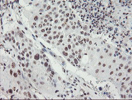 IHC of paraffin-embedded Carcinoma of Human lung tissue using anti-MLF2 mouse monoclonal antibody. (Heat-induced epitope retrieval by 10mM citric buffer, pH6.0, 100C for 10min).