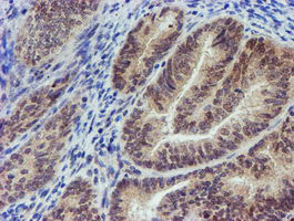 IHC of paraffin-embedded Adenocarcinoma of Human endometrium tissue using anti-MLF2 mouse monoclonal antibody.