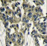Formalin-fixed and paraffin-embedded human breast carcinoma reacted with GBL antibody , which was peroxidase-conjugated to the secondary antibody, followed by DAB staining. This data demonstrates the use of this antibody for immunohistochemistry; clinical relevance has not been evaluated.