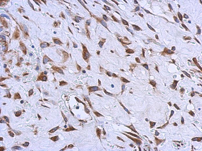 IHC of paraffin-embedded Hepatoma using MMACHC antibody at 1:500 dilution.