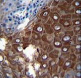 MMP1 Antibody immunohistochemistry of formalin-fixed and paraffin-embedded human esophageal carcinoma followed by peroxidase-conjugated secondary antibody and DAB staining.