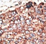 Formalin-fixed and paraffin-embedded human cancer tissue reacted with the primary antibody, which was peroxidase-conjugated to the secondary antibody, followed by DAB staining. This data demonstrates the use of this antibody for immunohistochemistry; clinical relevance has not been evaluated. BC = breast carcinoma; HC = hepatocarcinoma.