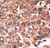 Formalin-fixed and paraffin-embedded human cancer tissue reacted with the primary antibody, which was peroxidase-conjugated to the secondary antibody, followed by DAB staining. This data demonstrates the use of this antibody for immunohistochemistry; clinical relevance has not been evaluated. BC = breast carcinoma; HC = hepatocarcinoma.