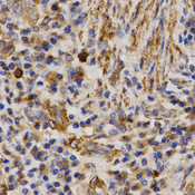 Immunohistochemistry of paraffin-embedded human lung cancer using MMP25 antibody at dilution of 1:200 (x400 lens).
