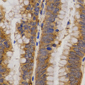 Immunohistochemistry of paraffin-embedded human rectal cancer using MMP25 antibody at dilution of 1:200 (x400 lens)