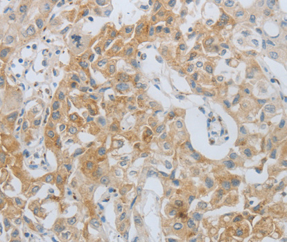 Immunohistochemistry of paraffin-embedded Human lung cancer tissue using MMP25 antibody.