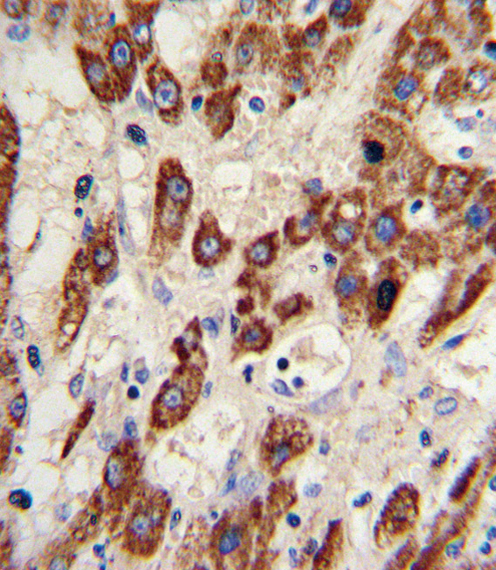 Formalin-fixed and paraffin-embedded human hepatocarcinoma reacted with MMP3 Antibody , which was peroxidase-conjugated to the secondary antibody, followed by DAB staining. This data demonstrates the use of this antibody for immunohistochemistry; clinical relevance has not been evaluated.