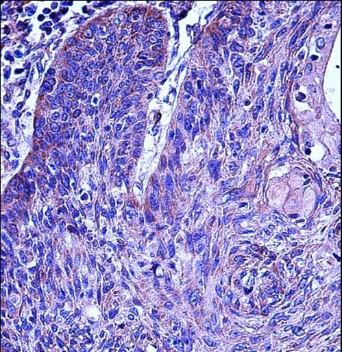 MMP3 Antibody immunohistochemistry of formalin-fixed and paraffin-embedded human esophagus carcinoma followed by peroxidase-conjugated secondary antibody and DAB staining.
