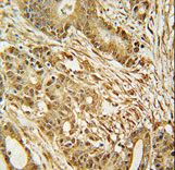MCM2 Antibody immunohistochemistry of formalin-fixed and paraffin-embedded human colon carcinoma followed by peroxidase-conjugated secondary antibody and DAB staining.