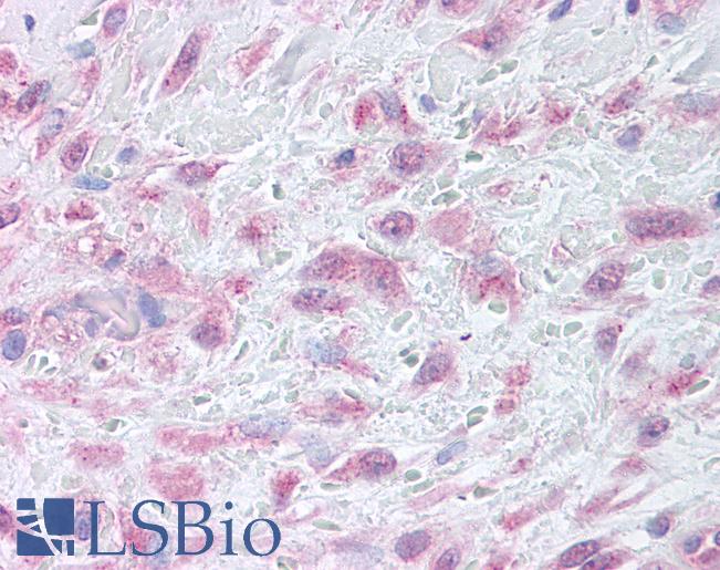 Anti-MMP9 antibody LS-A9461 IHC of human skin, granulation tissue. Immunohistochemistry of formalin-fixed, paraffin-embedded tissue after heat-induced antigen retrieval.