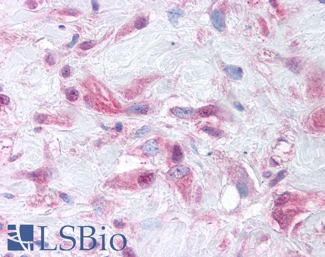 Anti-MMP9 antibody LS-A9463 IHC of human skin, granulation tissue. Immunohistochemistry of formalin-fixed, paraffin-embedded tissue after heat-induced antigen retrieval.