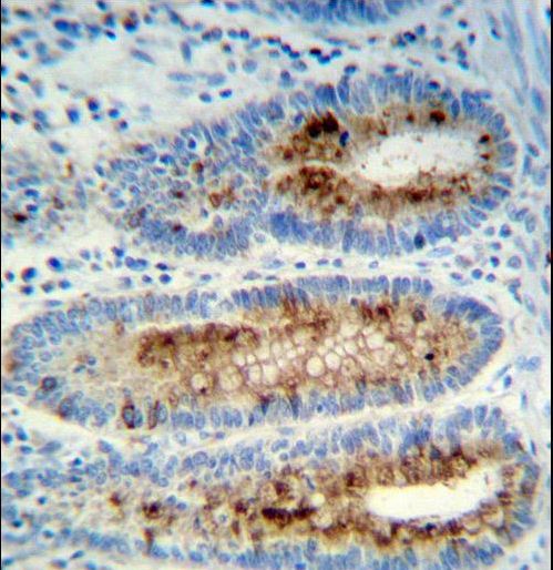 Myeloperoxidase Antibody immunohistochemistry of formalin-fixed and paraffin-embedded human colon tissue followed by peroxidase-conjugated secondary antibody and DAB staining.This data demonstrates the use of Myeloperoxidase Antibody for immunohistochemistry.