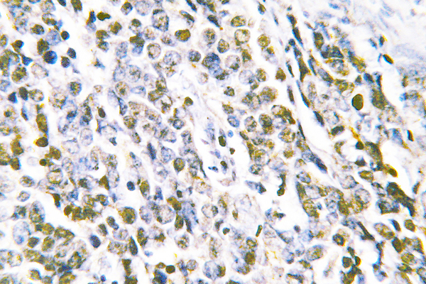 IHC of MRE11 (L260) pAb in paraffin-embedded human lung carcinoma tissue.