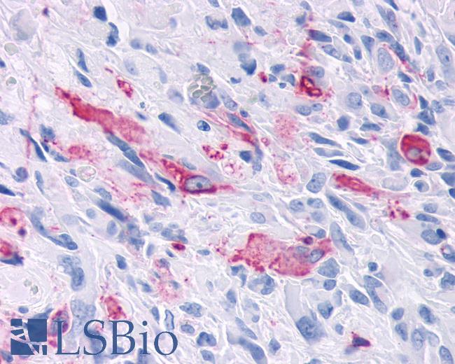 Anti-MRGD / MRGPRD antibody IHC of human Brain, Glioblastoma. Immunohistochemistry of formalin-fixed, paraffin-embedded tissue after heat-induced antigen retrieval.