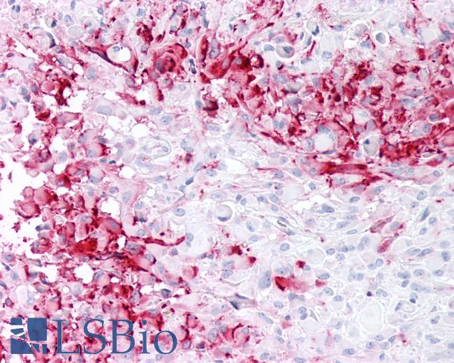 Anti-MRGD / MRGPRD antibody IHC of human Brain, Glioblastoma. Immunohistochemistry of formalin-fixed, paraffin-embedded tissue after heat-induced antigen retrieval.