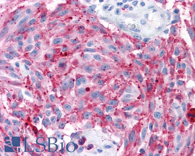 Anti-MRGD / MRGPRD antibody IHC of human Skin, Melanoma. Immunohistochemistry of formalin-fixed, paraffin-embedded tissue after heat-induced antigen retrieval.