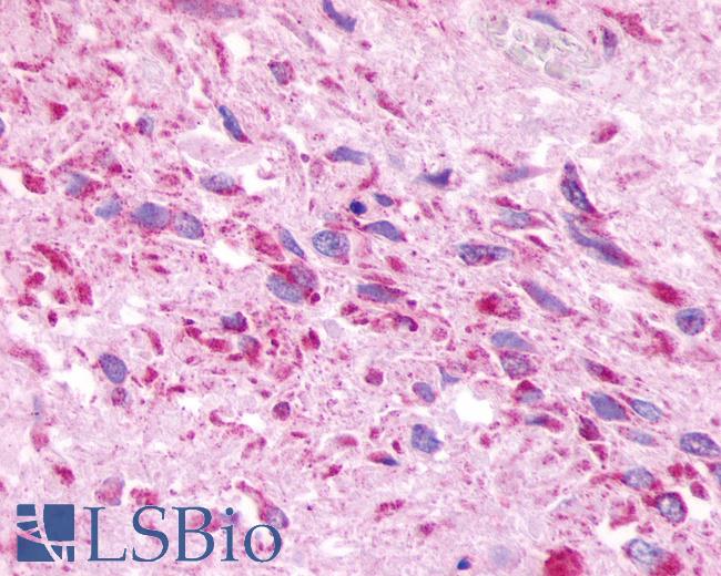 Anti-MRGPRE / MRGE antibody IHC of human Brain, Glioblastoma. Immunohistochemistry of formalin-fixed, paraffin-embedded tissue after heat-induced antigen retrieval.