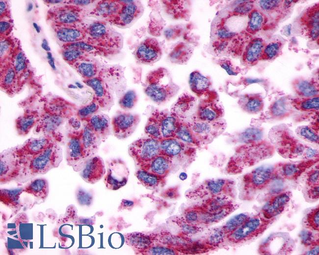 Anti-MRGPRE / MRGE antibody IHC of human Lung, Adenocarcinoma. Immunohistochemistry of formalin-fixed, paraffin-embedded tissue after heat-induced antigen retrieval.