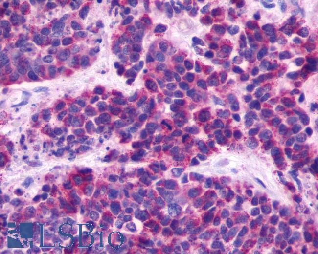 Anti-MRGPRE / MRGE antibody IHC of human Lung, Small Cell Carcinoma. Immunohistochemistry of formalin-fixed, paraffin-embedded tissue after heat-induced antigen retrieval.