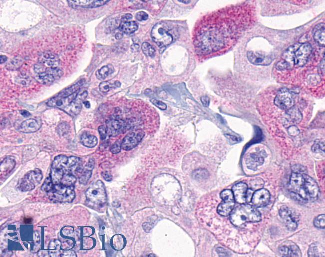 Anti-MRGPRF antibody IHC of human Ovary, Carcinoma. Immunohistochemistry of formalin-fixed, paraffin-embedded tissue after heat-induced antigen retrieval.