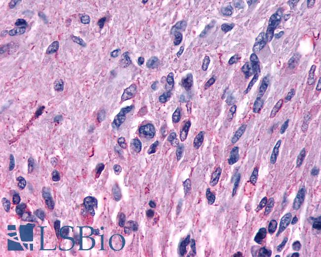 Anti-MRGPRF antibody IHC of human Brain, Glioblastoma. Immunohistochemistry of formalin-fixed, paraffin-embedded tissue after heat-induced antigen retrieval.