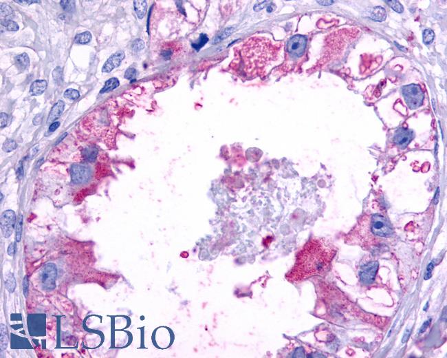 Anti-MRGPRX2 / MRGX2 antibody IHC of human Ovary, Carcinoma. Immunohistochemistry of formalin-fixed, paraffin-embedded tissue after heat-induced antigen retrieval.