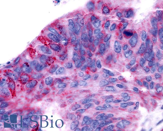 Anti-MRGPRX2 / MRGX2 antibody IHC of human Colon, Carcinoma. Immunohistochemistry of formalin-fixed, paraffin-embedded tissue after heat-induced antigen retrieval.