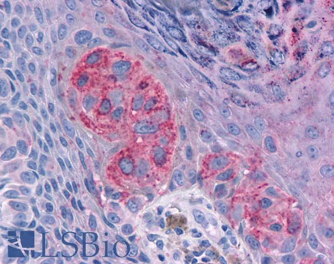 Anti-MRGPRX2 / MRGX2 antibody IHC of human Skin, Melanoma. Immunohistochemistry of formalin-fixed, paraffin-embedded tissue after heat-induced antigen retrieval.