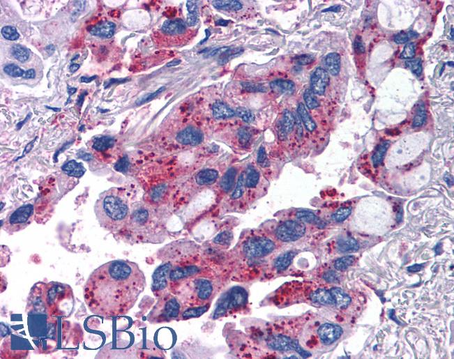 Anti-MRGPRX2 / MRGX2 antibody IHC of human Lung, Non-Small Cell Carcinoma. Immunohistochemistry of formalin-fixed, paraffin-embedded tissue after heat-induced antigen retrieval.