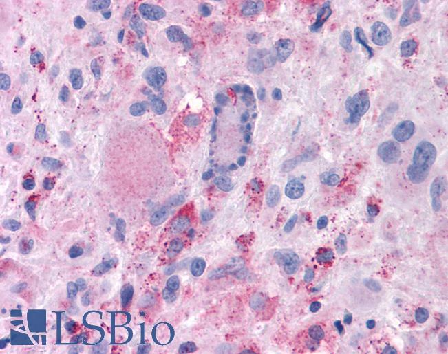 Anti-MRGPRX2 / MRGX2 antibody IHC of human Brain, Glioblastoma. Immunohistochemistry of formalin-fixed, paraffin-embedded tissue after heat-induced antigen retrieval.