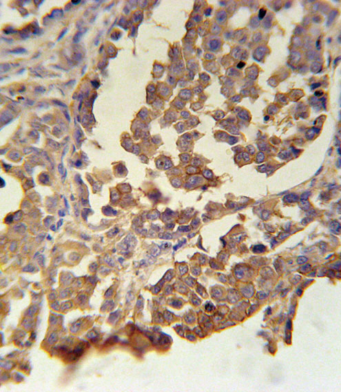 MC2R Antibody immunohistochemistry of formalin-fixed and paraffin-embedded human skin carcinoma followed by peroxidase-conjugated secondary antibody and DAB staining.