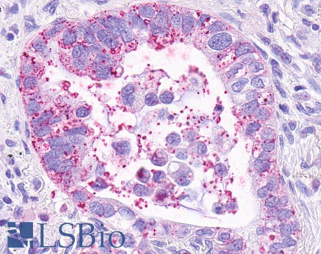 Anti-MRGPRX3 / MRGX3 antibody IHC of human Lung, Adenocarcinoma. Immunohistochemistry of formalin-fixed, paraffin-embedded tissue after heat-induced antigen retrieval.