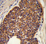 Formalin-fixed and paraffin-embedded human prostate carcinoma reacted with MTBP Antibody , which was peroxidase-conjugated to the secondary antibody, followed by DAB staining. This data demonstrates the use of this antibody for immunohistochemistry; clinical relevance has not been evaluated.