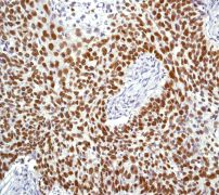 IHC of paraffin-embedded human squamous cell cervical carcinoma using anti-MCM5 antibody. (LS-C105340).