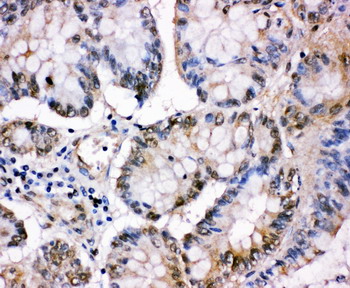 MCM5 antibody. IHC(P): Human Intestinal Cancer Tissue.
