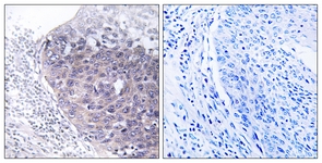 IHC of paraffin-embedded human cervix carcinoma tissue, using GTPBP5 Antibody. The sample on the right was incubated with synthetic peptide.
