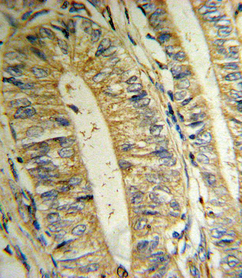 Formalin-fixed and paraffin-embedded human Colon carcinoma reacted with MTHFD2 Antibody , which was peroxidase-conjugated to the secondary antibody, followed by DAB staining. This data demonstrates the use of this antibody for immunohistochemistry; clinical relevance has not been evaluated.