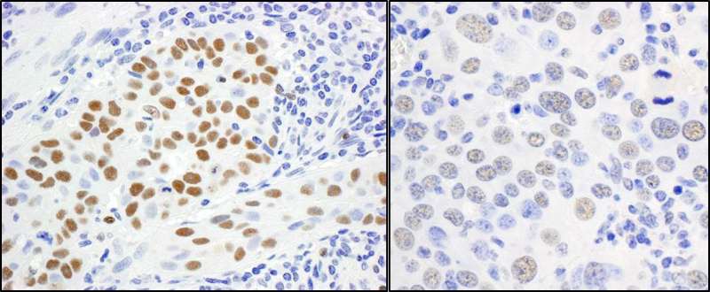 Detection of Human and Mouse MCM5 by Immunohistochemistry. Sample: FFPE sections of human lung carcinoma (left) and mouse renal cell carcinoma (right). Antibody: Affinity purified rabbit anti-MCM5 used at a dilution of 1:1000 (1 ug/ml). Detection: DAB.