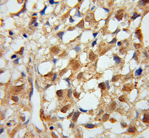 Immunohistochemistry of paraffin-embedded Osteosarcoma using MTM1 antibody.