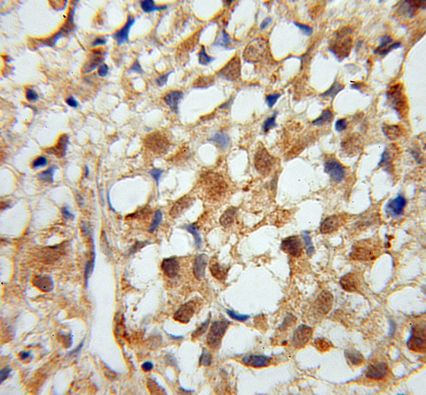 Immunohistochemistry (IHC) analysis of MTM1 pAb in paraffin-embedded Osteosarcoma tissue.